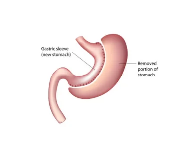 Gastric sleeve