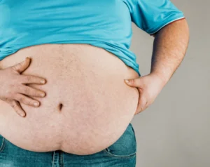 Morbid obesity