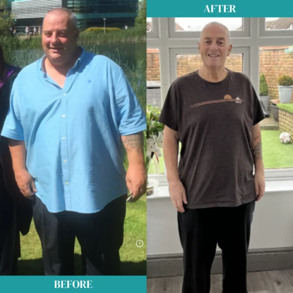 Paul Gastric Bypass Before and After