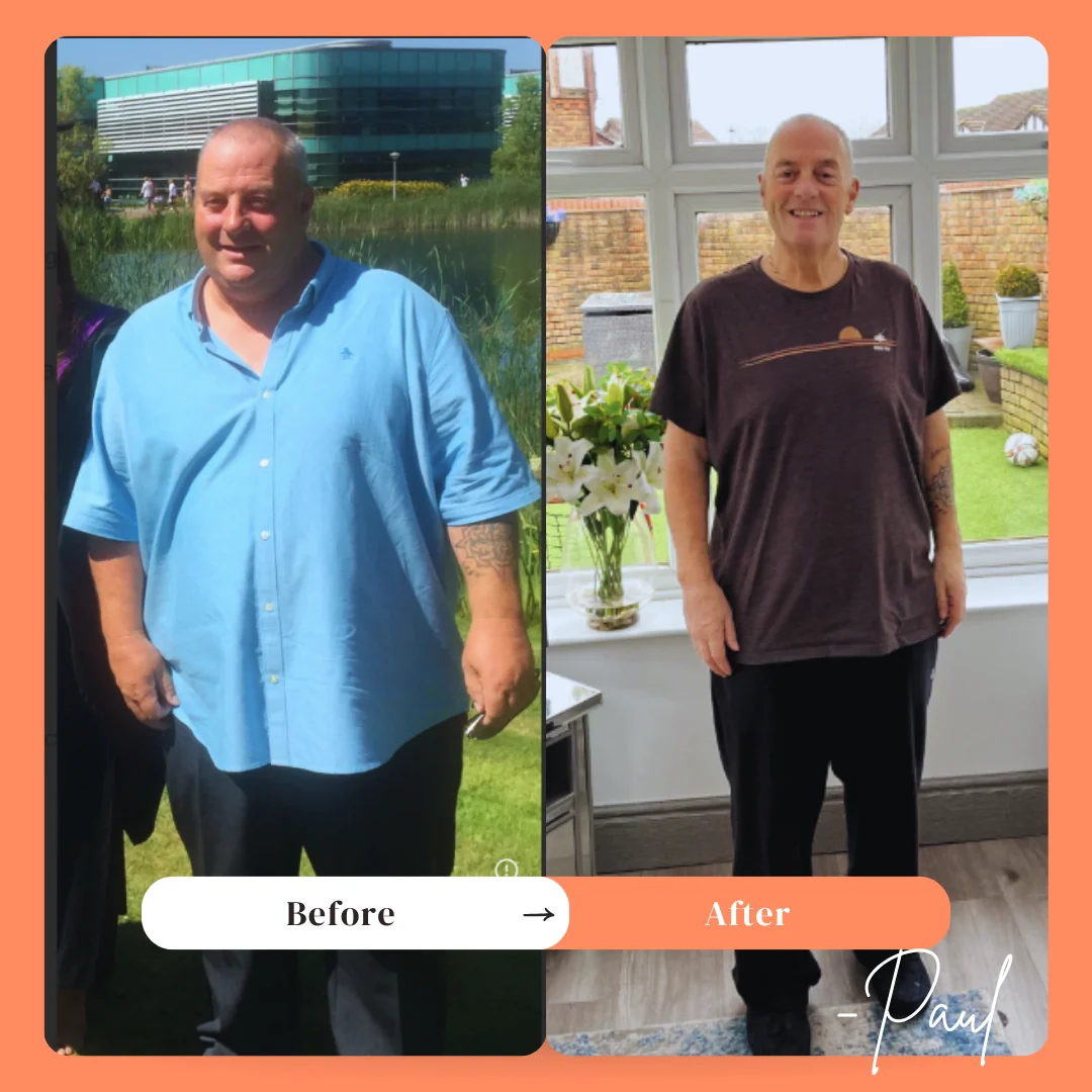 Gastric Bypass Surgery before and after - Paul