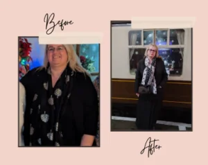 mini gastric bypass before after