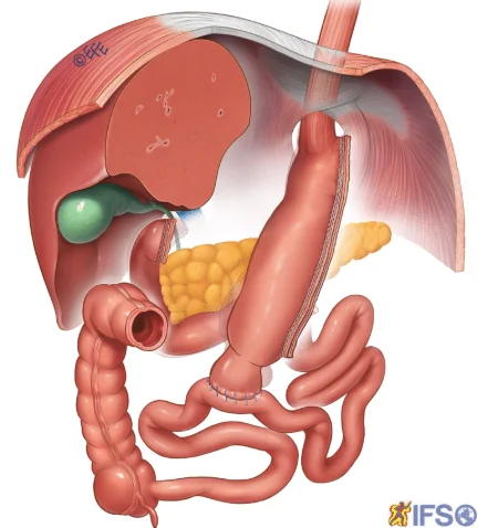 Sadi-S Procedure