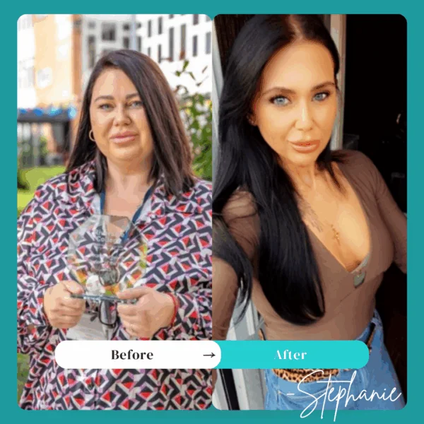 Stephanie Mini gastric bypass before and after