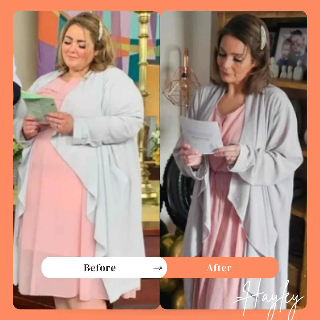 Before and after mini gastric bypass