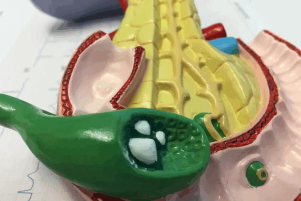 Gallstones Removal