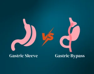 Gastric Sleeve Vs Gastric Bypass