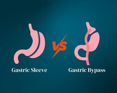 Gastric Sleeve Vs Gastric Bypass
