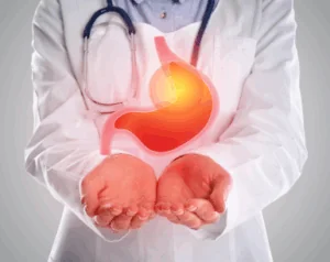 Acid Reflux After Gastric Sleeve