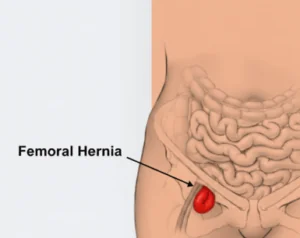 Femoral Hernia Image