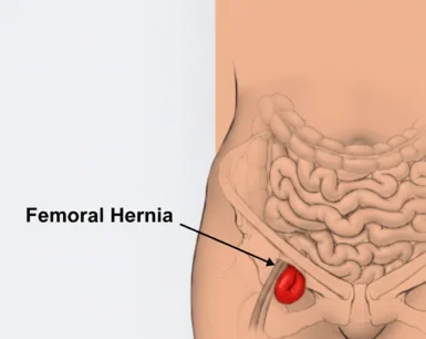 Femoral Hernia Image