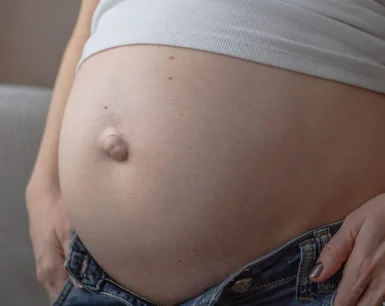 Umblical Hernia
