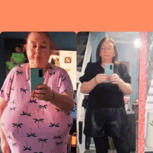 weight loss surgery success story